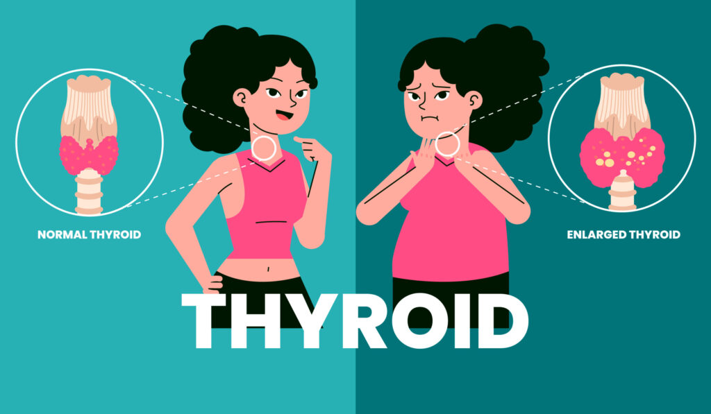 Hypothyroidism: Physiology, Medical Nutrition Therapy (MNT) & How Diet Supports Thyroid Health