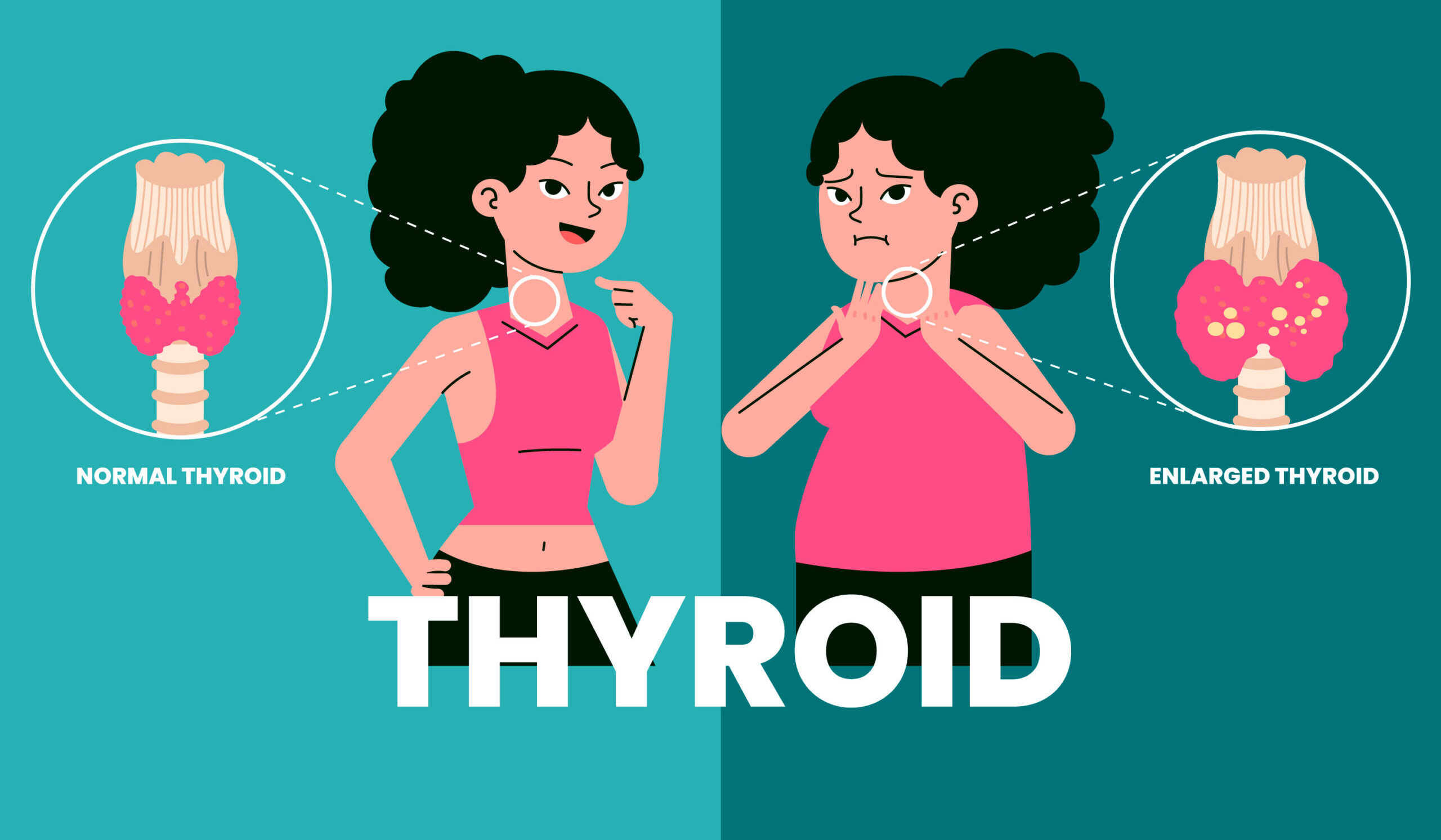 Hypothyroidism: Physiology, Medical Nutrition Therapy (MNT) & How Diet Supports Thyroid Health